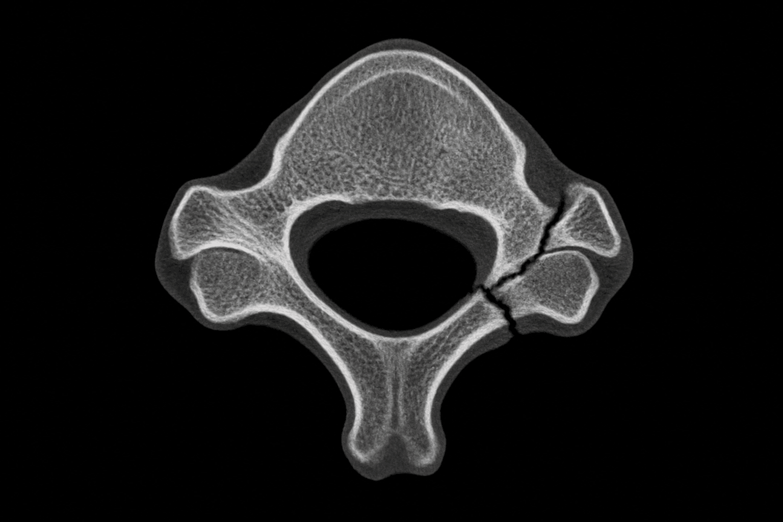 Axial CT of a cervical vertebra showing fractures through the lamina and pedicle isolating the lateral mass