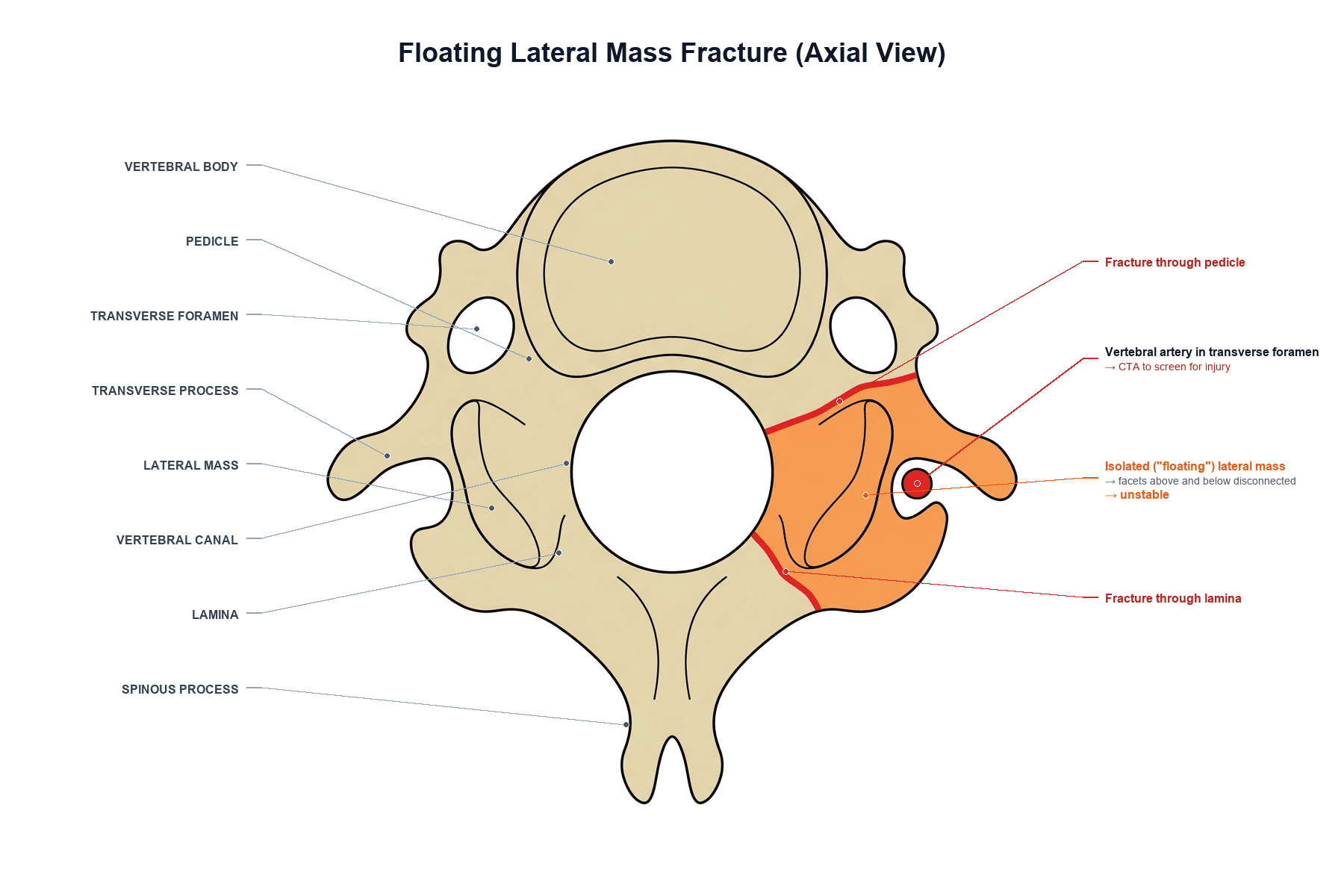 Axial diagram of a cervical vertebra with fractures through the pedicle and lamina on one side isolating the lateral mass, and the vertebral artery in the adjacent transverse foramen