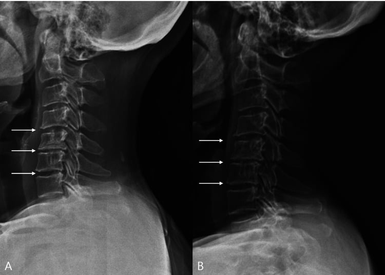Lateral cervical radiographs showing multilevel disc-space narrowing at C4-5 through C6-7