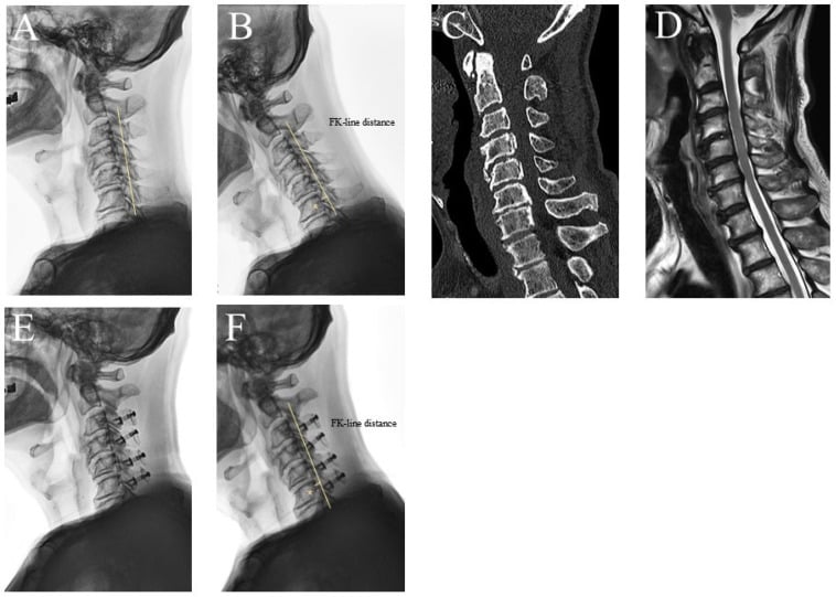 Neutral and flexion cervical radiographs with CT and MRI illustrating dynamic K-line assessment in OPLL