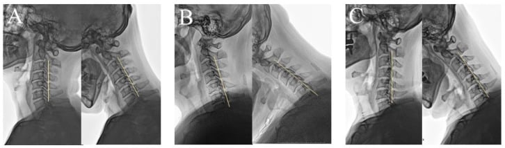 Neutral and flexion radiographs demonstrating the three dynamic K-line groups in multilevel cervical OPLL