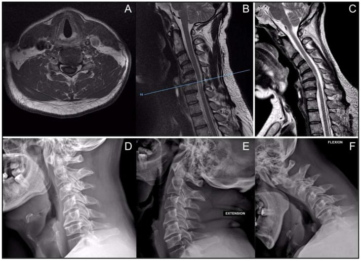 Axial and sagittal cervical MRI with dynamic flexion and extension radiographs in degenerative cervical myelopathy