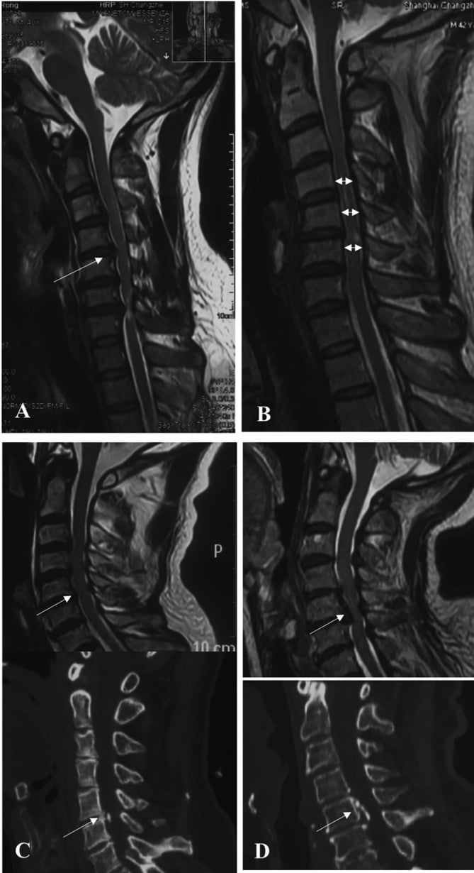 Sagittal and axial cervical MRI and CT examples of disc herniation, cervical stenosis, disc-osteophyte complex and ossification of the posterior longitudinal ligament