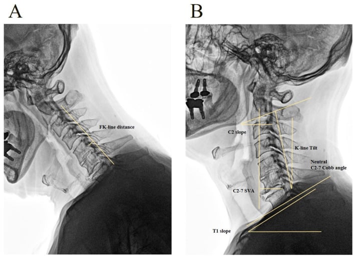 Flexion K-line distance and cervical sagittal alignment parameters on lateral radiographs