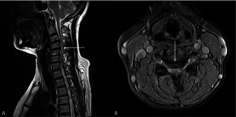 Sagittal and axial T2-weighted cervical MRI showing multilevel disc protrusion and spinal cord compression