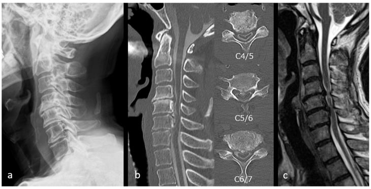 Preoperative lateral radiograph, CT and sagittal T2 MRI showing cervical OPLL and multilevel cord compression
