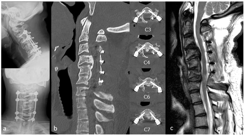 Postoperative radiograph, CT and MRI after posterior cervical decompression and fixation