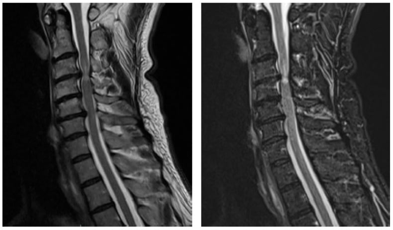 Sagittal T2-weighted cervical MRI showing multilevel anterior cord compression and intramedullary signal