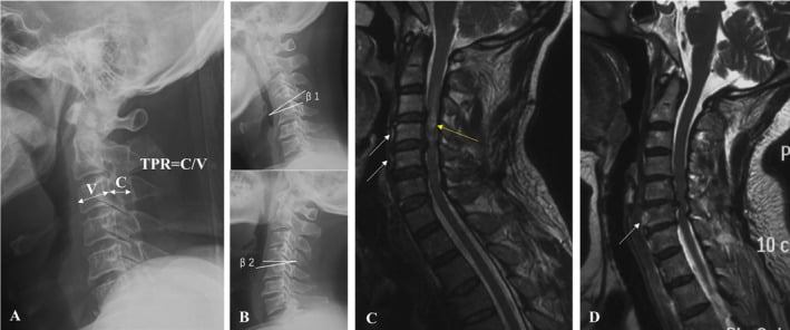 Lateral cervical radiograph measuring the Torg-Pavlov ratio with flexion and extension views and MRI cord signal change