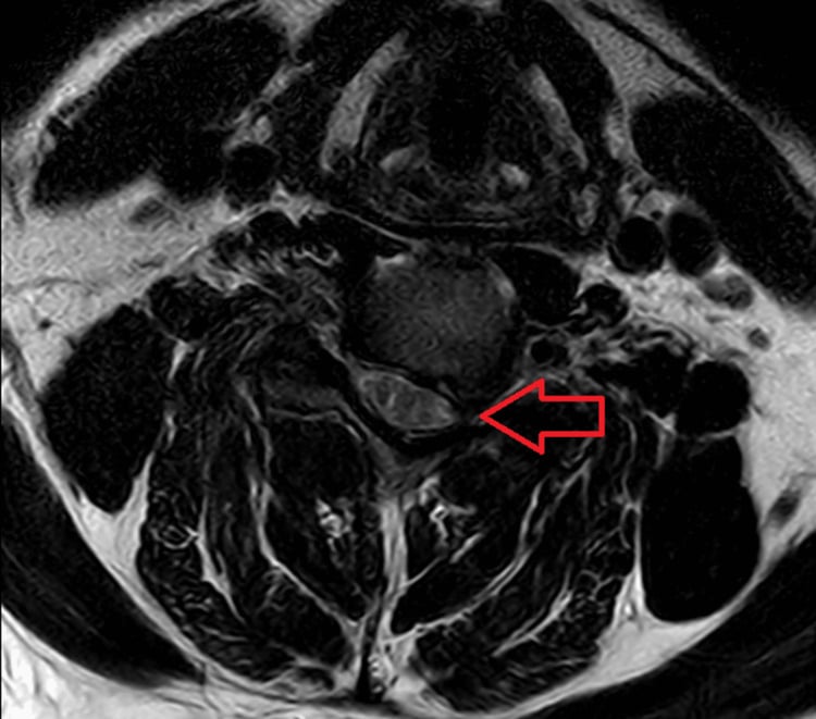 Axial MRI at C5-C6 showing unilateral neural foraminal narrowing marked by a single red arrow.