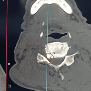 Axial CT (panel b) showing an osteophyte, circled, narrowing the neural foramen at C5-C6.