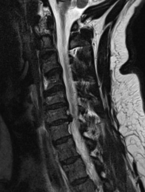 Sagittal T2-weighted cervical MRI showing a posterior C6-C7 disc herniation indenting the ventral thecal sac.