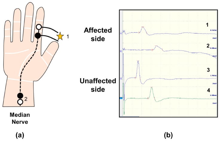 Median sensory nerve conduction setup and waveforms showing delayed distal latency and reduced amplitude in carpal tunnel syndrome.