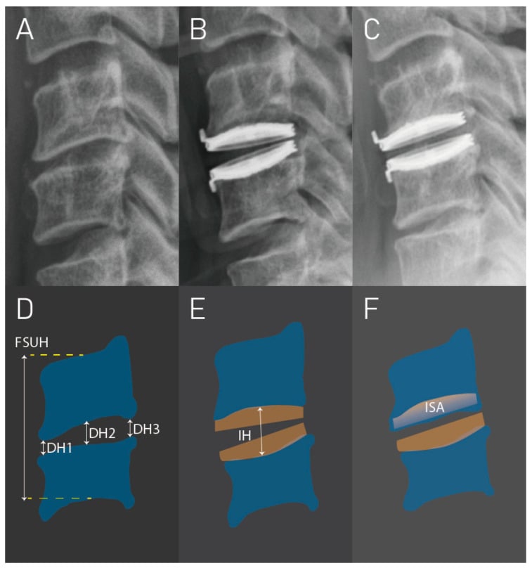 Six-panel figure: three lateral radiographs of a cervical disc arthroplasty before surgery, after implantation and at follow-up, with three diagrams defining the measurements used to grade subsidence.
