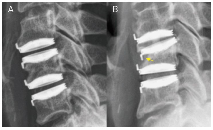 Two lateral radiographs after two-level cervical disc arthroplasty, the follow-up film showing subsidence of the upper implant marked by an arrow.
