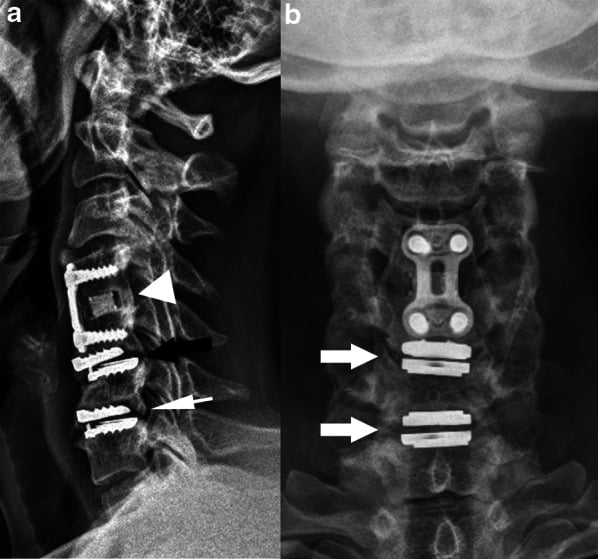 Lateral (a) and anteroposterior (b) radiographs showing a plated C4-C5 anterior cervical fusion above two adjacent disc arthroplasties marked by arrows.