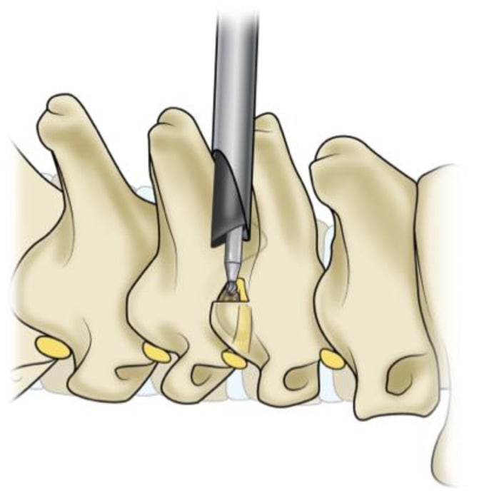 Illustration of a guarded high-speed burr creating a posterior cervical keyhole foraminotomy beside the exiting nerve root.