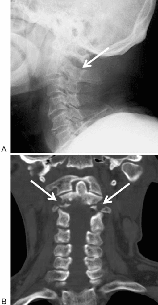 Two-panel cervical spine imaging in a 67-year-old man with a C2-C4 fracture after a fall: (A) lateral radiograph with an arrow indicating the fracture, and (B) coronal CT reconstruction with arrows showing the fracture.