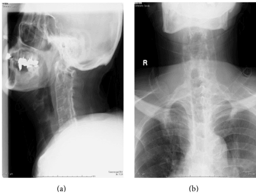 Two-panel radiographs of an ankylosing spondylitis patient with an occult cervical fracture: (a) lateral view showing a bamboo-spine appearance and (b) AP view showing a fused spine, illustrating how hard the fracture is to detect on plain films.