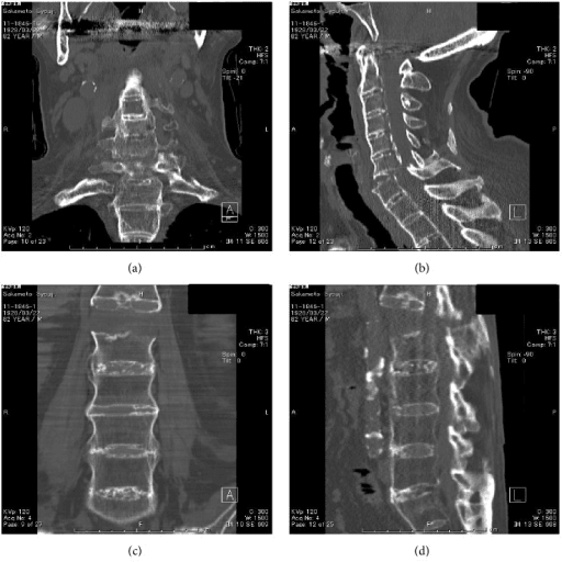 Multiplanar CT showing simultaneous cervical (C6-C7) and lumbar (L1) fracture-dislocations in a patient with ankylosing spondylitis