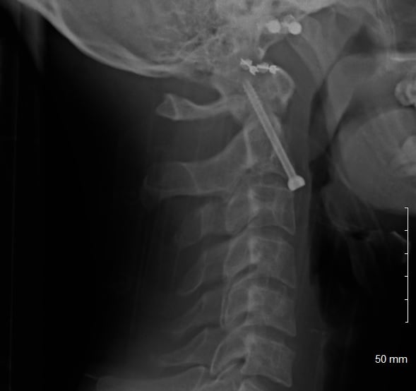 Lateral cervical spine X-ray showing anterior odontoid screw fixation