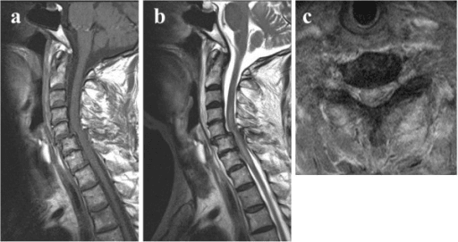 Cervical spine MRI showing subaxial canal stenosis and spinal cord swelling after a traumatic cervical injury