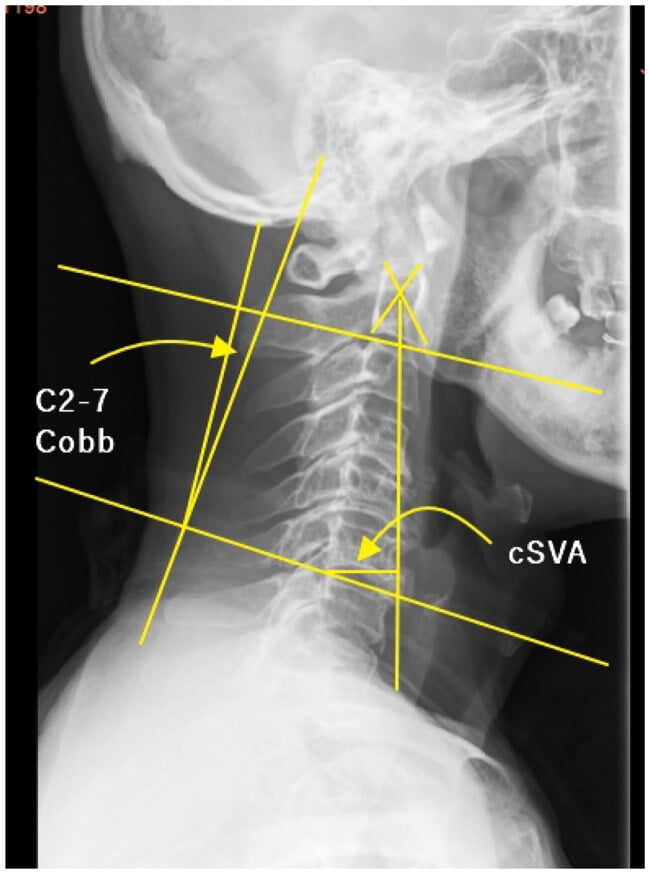 Lateral cervical radiograph illustrating C2-C7 Cobb angle and cervical sagittal vertical axis measurement