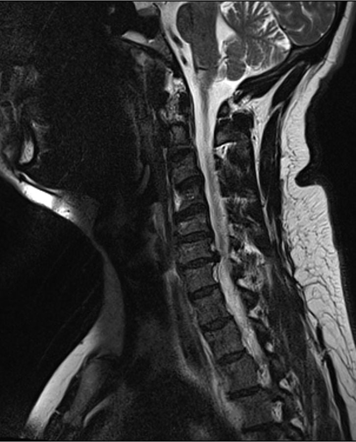Sagittal T2 cervical MRI showing a C6-7 disc herniation indenting the spinal cord