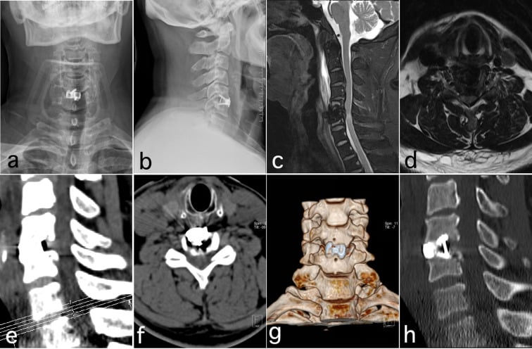Postoperative radiographs, MRI, CT and 3D CT reconstruction showing ACDF cage position and decompression