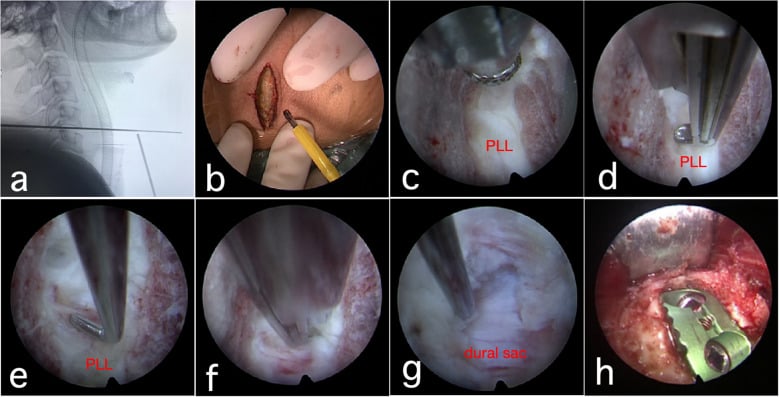 Illustrated endoscopic anterior cervical decompression sequence showing level check, endplate preparation, PLL work and cage placement