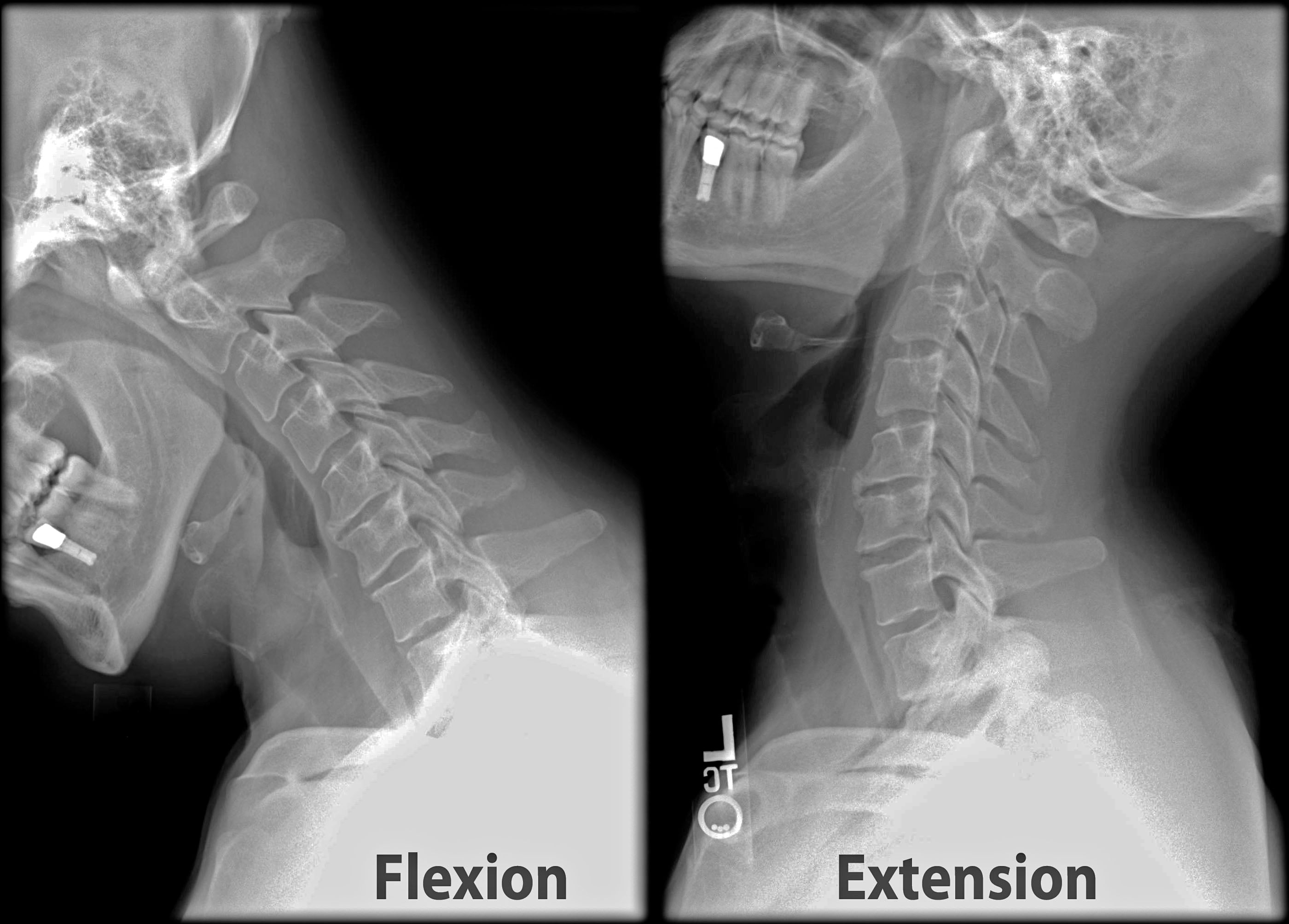 Lateral cervical spine radiographs in flexion and extension for dynamic instability assessment