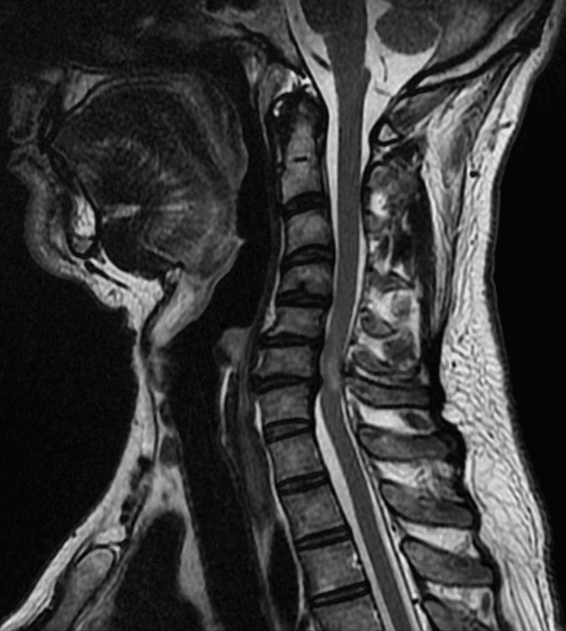 Sagittal T2 cervical MRI of multilevel spondylosis with straightened lordosis and cord compression