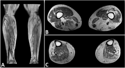 T1-weighted lower-limb MRI showing distal-predominant fatty muscle atrophy in CMT