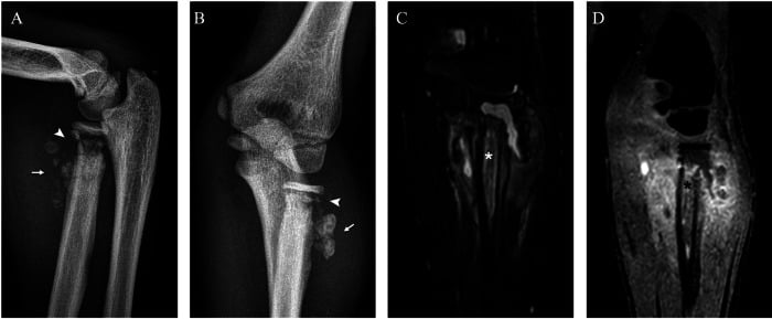 Radiographs and MRI of a neuropathic (Charcot) elbow showing lysis, bone fragments, and marrow oedema