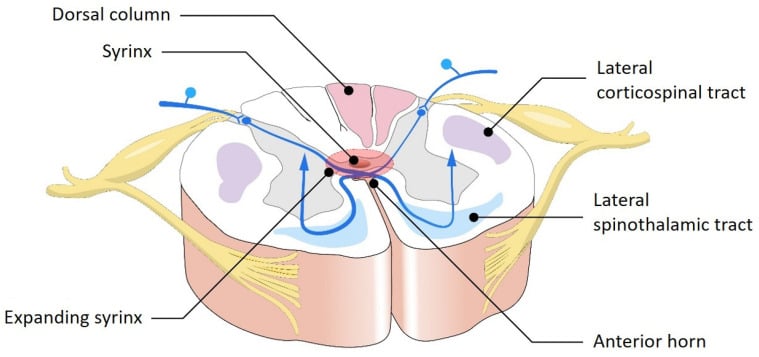 Schematic cross-section of the spinal cord showing how an expanding syrinx disrupts the decussating spinothalamic tract while sparing the dorsal columns