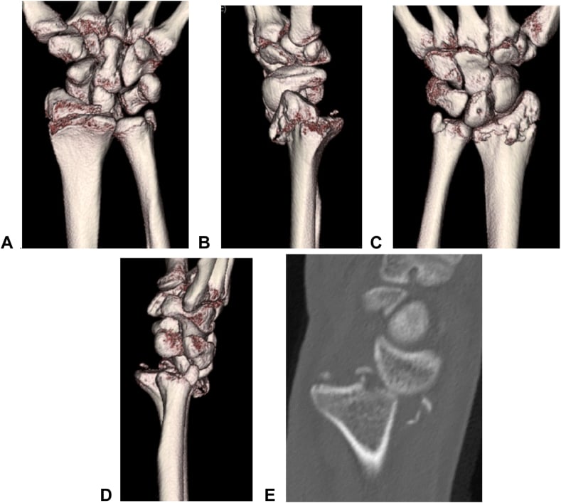 Three-dimensional CT and sagittal reconstruction of a radial styloid fracture with dorsal rim avulsion and radiocarpal dislocation