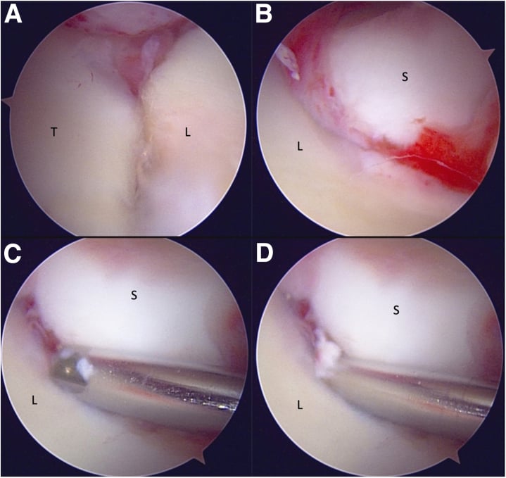 Midcarpal arthroscopy showing scapholunate step-off and passage of instruments through an incompetent scapholunate interval