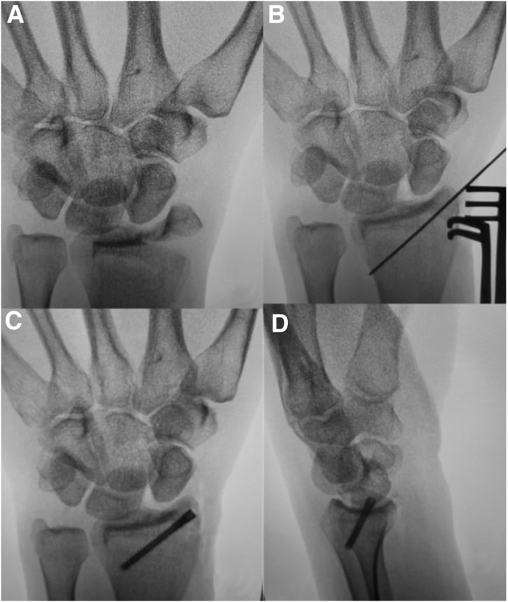 Fluoroscopic sequence showing reduction and headless compression screw fixation of a radial styloid fracture