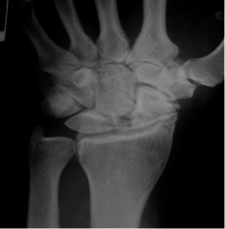 PA wrist radiograph showing scapholunate widening and stage two scapholunate advanced collapse