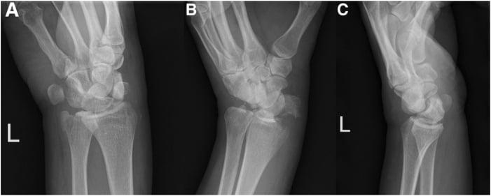 PA, oblique and lateral wrist radiographs showing radial and ulnar styloid fractures with perilunate malalignment