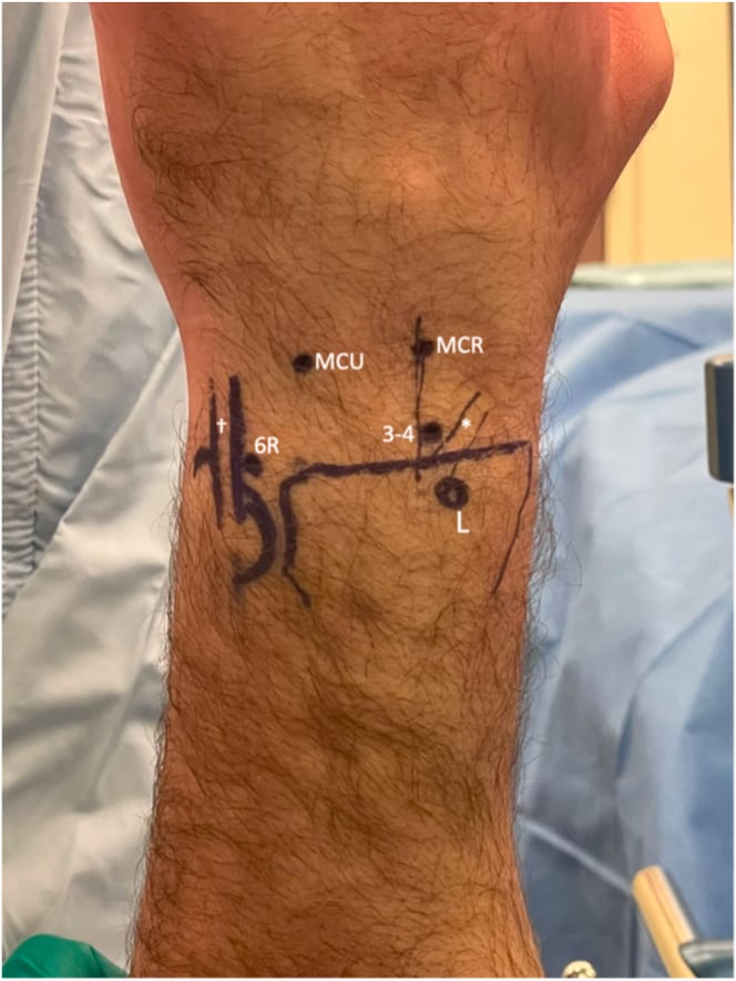 Dorsal wrist markings for 3-4, 6R, midcarpal radial and midcarpal ulnar arthroscopy portals