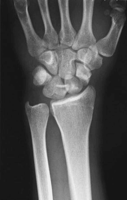 PA wrist X-ray showing scaphoid fracture with Gilula's arc disruption