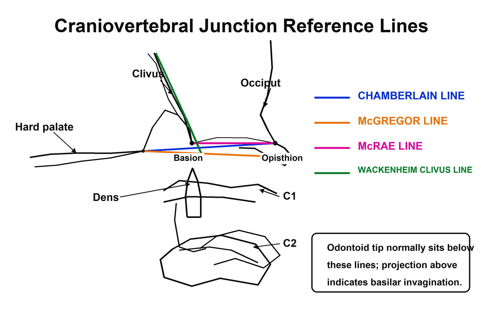Midsagittal schematic of the craniovertebral junction showing the four reference lines (Chamberlain, McGregor, McRae, Wackenheim) used to assess basilar invagination, with the hard palate, clivus, occiput, basion, opisthion, dens and C1-C2 labelled.