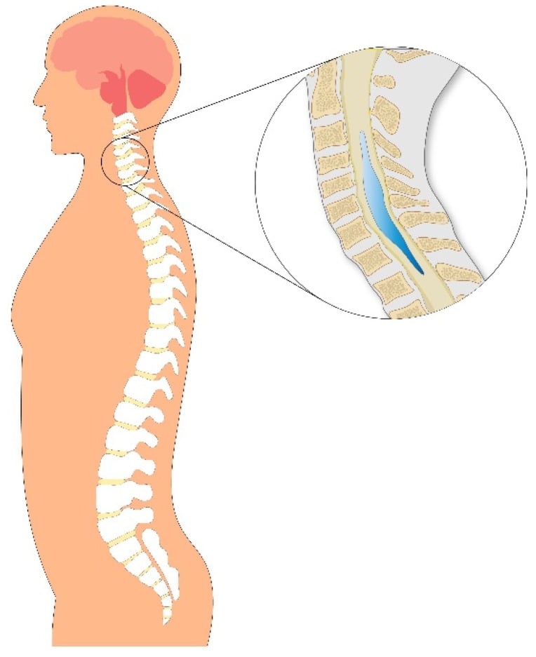 Schematic illustration of syringomyelia showing a fluid-filled cavity within the spinal cord
