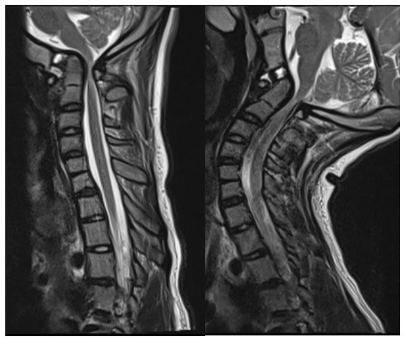 Mid-sagittal T2 MRI in neutral and extension showing canal stenosis with cord signal change