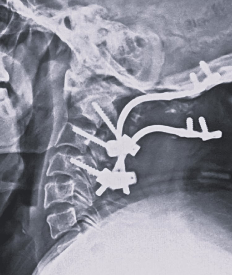 Lateral radiograph showing implant failure following occipitocervical fusion