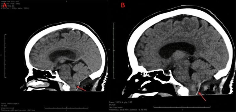Postoperative sagittal head CT showing suboccipital craniectomy after posterior fossa decompression and duraplasty