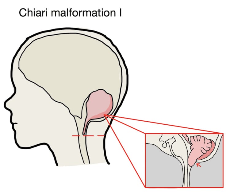 Schematic illustration of Chiari I malformation with tonsillar descent through the foramen magnum