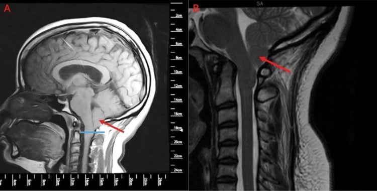Preoperative sagittal T1 MRI with tonsillar ectopia measured below McRae line