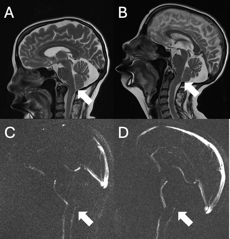 Sagittal T2 MRI of the craniocervical junction in neutral and flexion showing low-lying tonsils